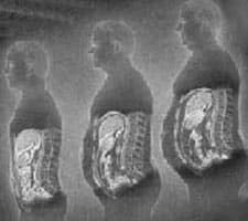 When gluten intolerance causes weight gain