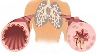 How are celiac disease and asthma related?